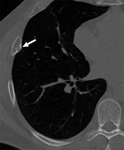 關於肋骨病變ct總結
