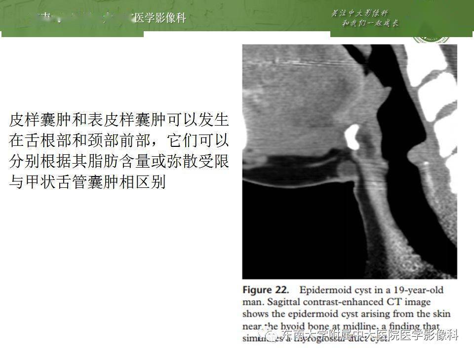 異位甲狀腺甲狀舌管囊腫影像表現