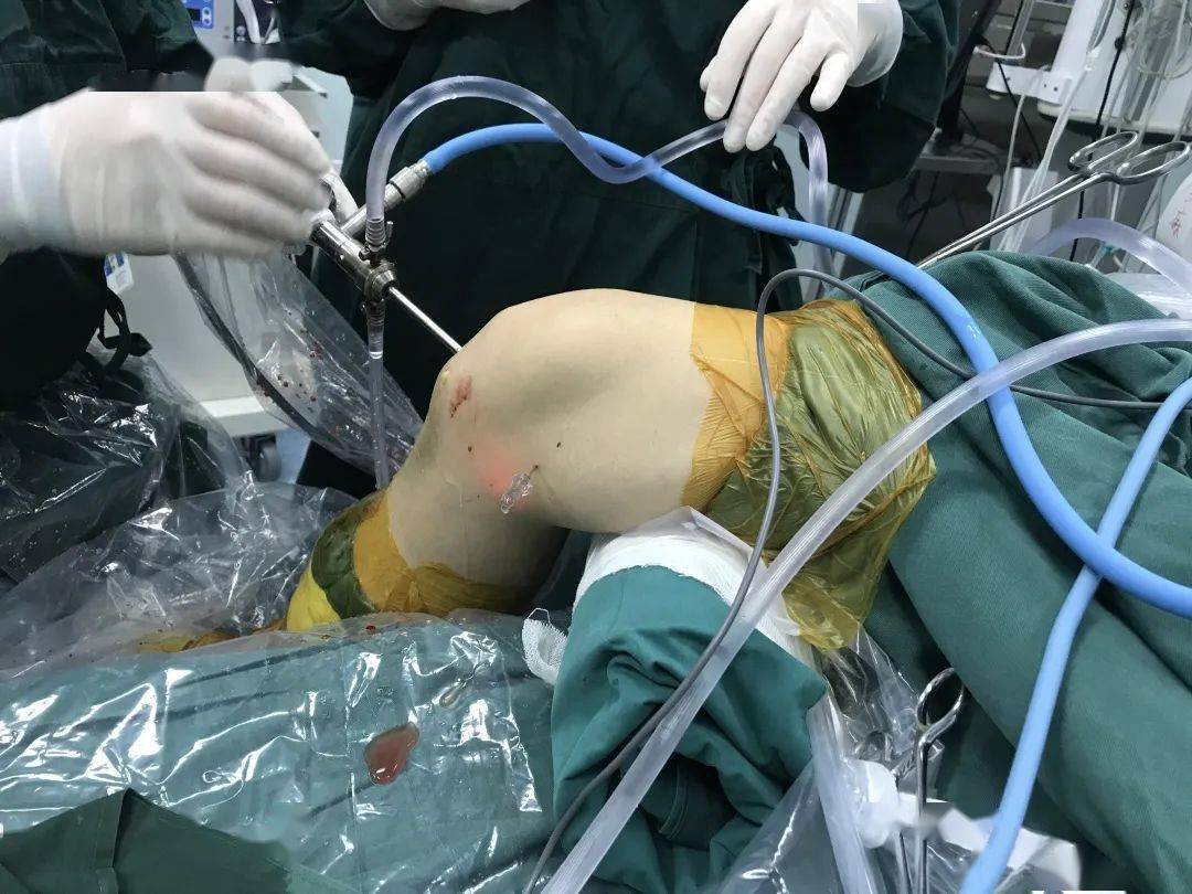 本研究旨在通过悬吊技术评估关节镜治疗急性后交叉韧带(pcl)撕脱性