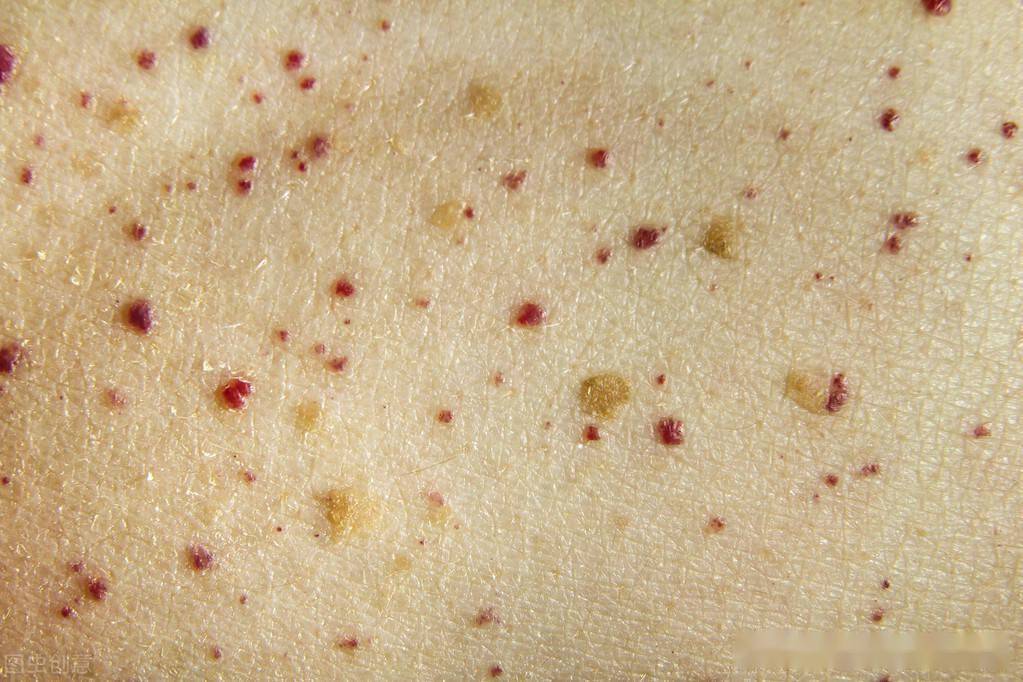 说说你身上的那些痣