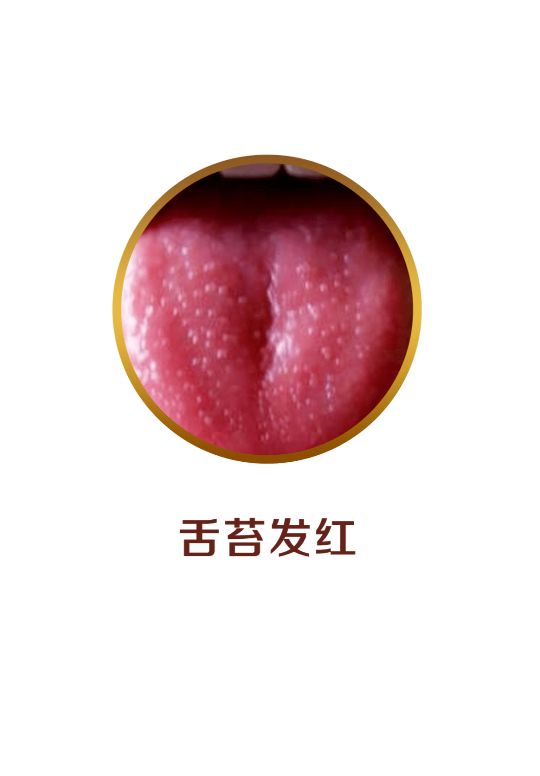 舌头两边菜花一样图片 菜花状疣初期图片