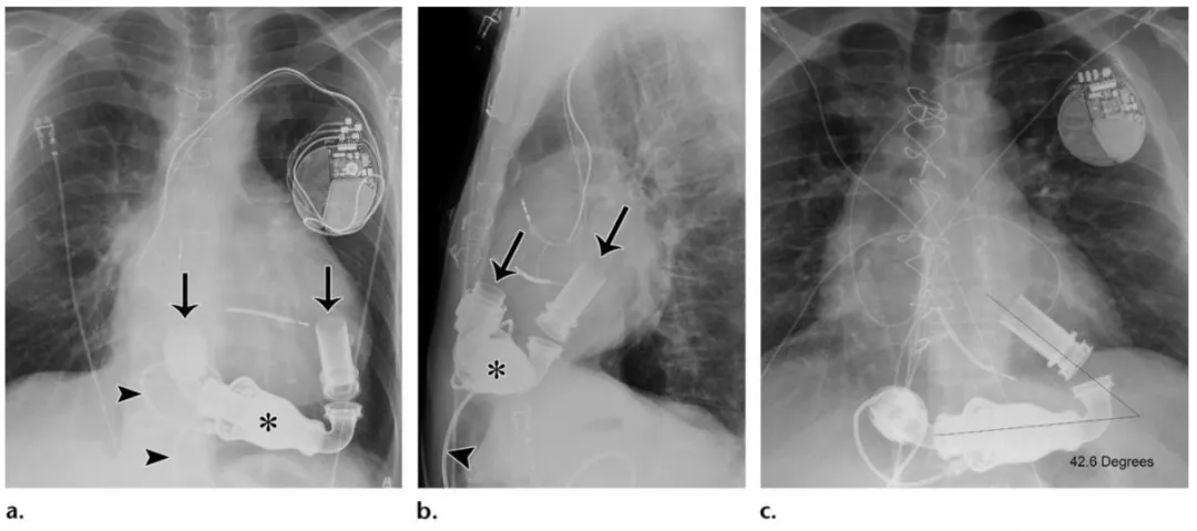 胸部治疗和监护设备的x线表现大全