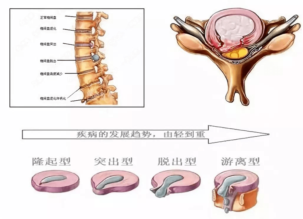 胸腰椎骨折分型图片图片
