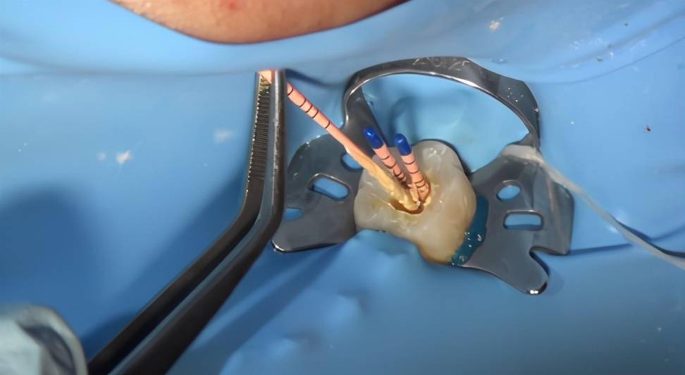 宝宝蛀牙越不疼越可怕!后面可能有"敲骨吸髓"手术等着它_牙髓