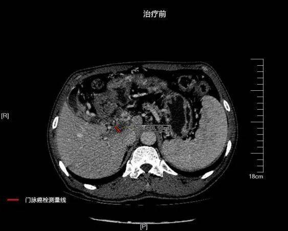 曙光動態我院超聲醫學中心成功運用高強度聚焦超聲hifu治療門靜脈癌栓