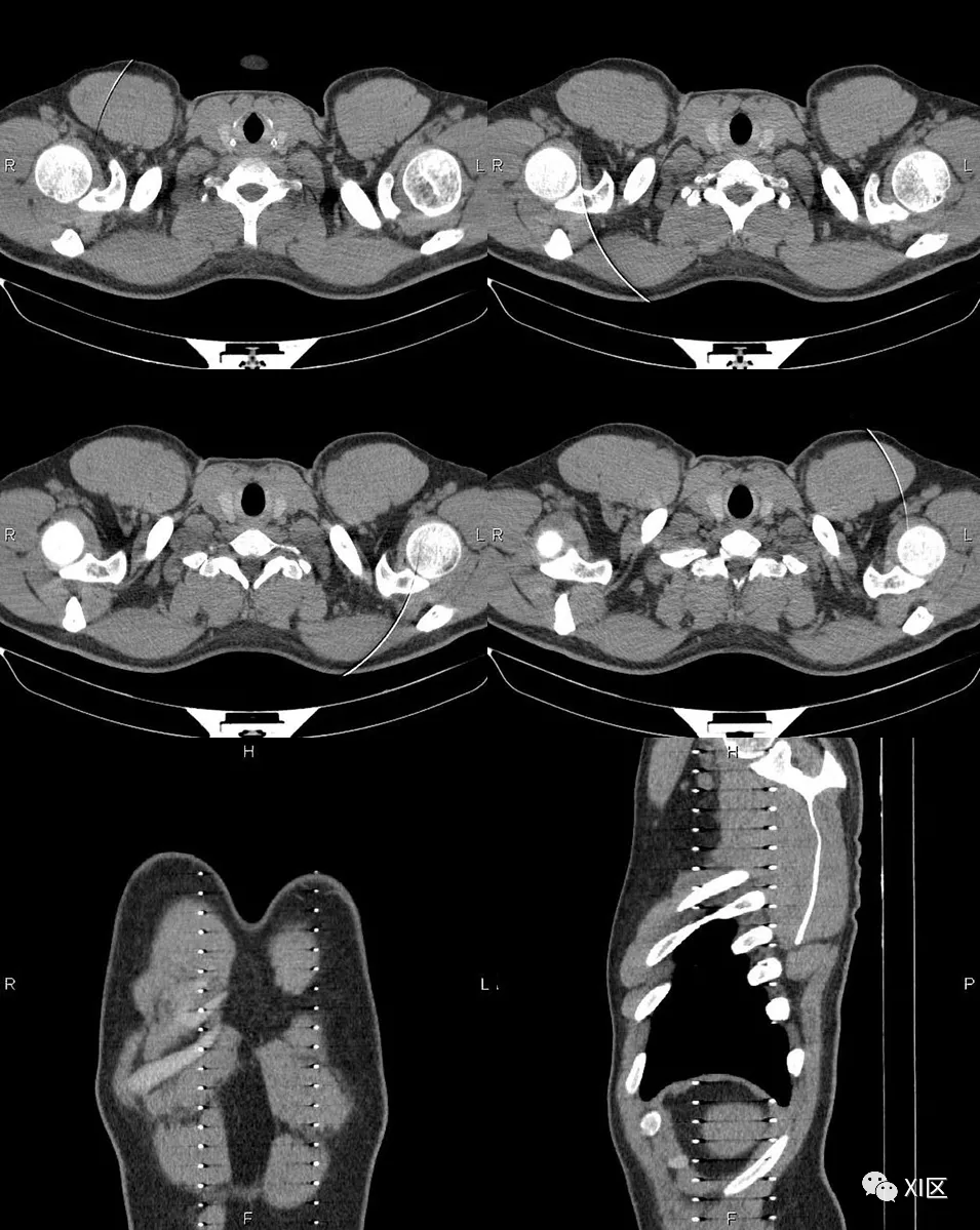 ct伪影根本原因与规避方法