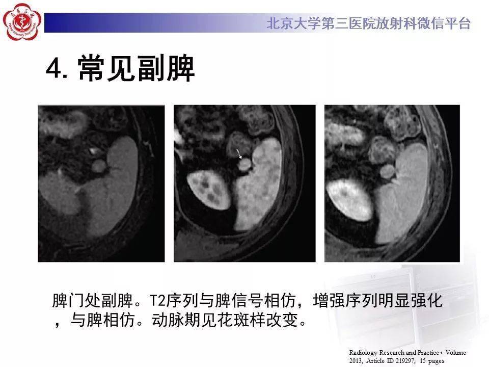 副脾蒂扭转少见部位副脾影像表现