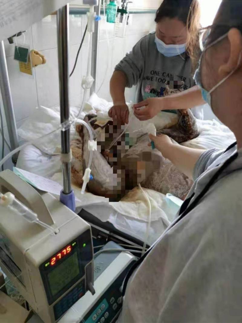 女子提分手遭男友泼汽油致特重烧伤 病床上称判他死刑不至于 张某燕