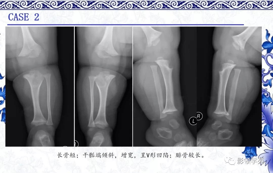 7种常见的骨软骨发育异常x线表现