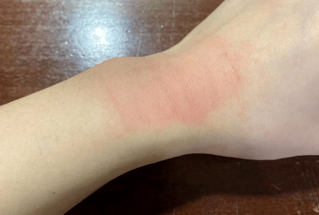 错!膏药这样贴效果才好!但这些人千万慎用_皮肤