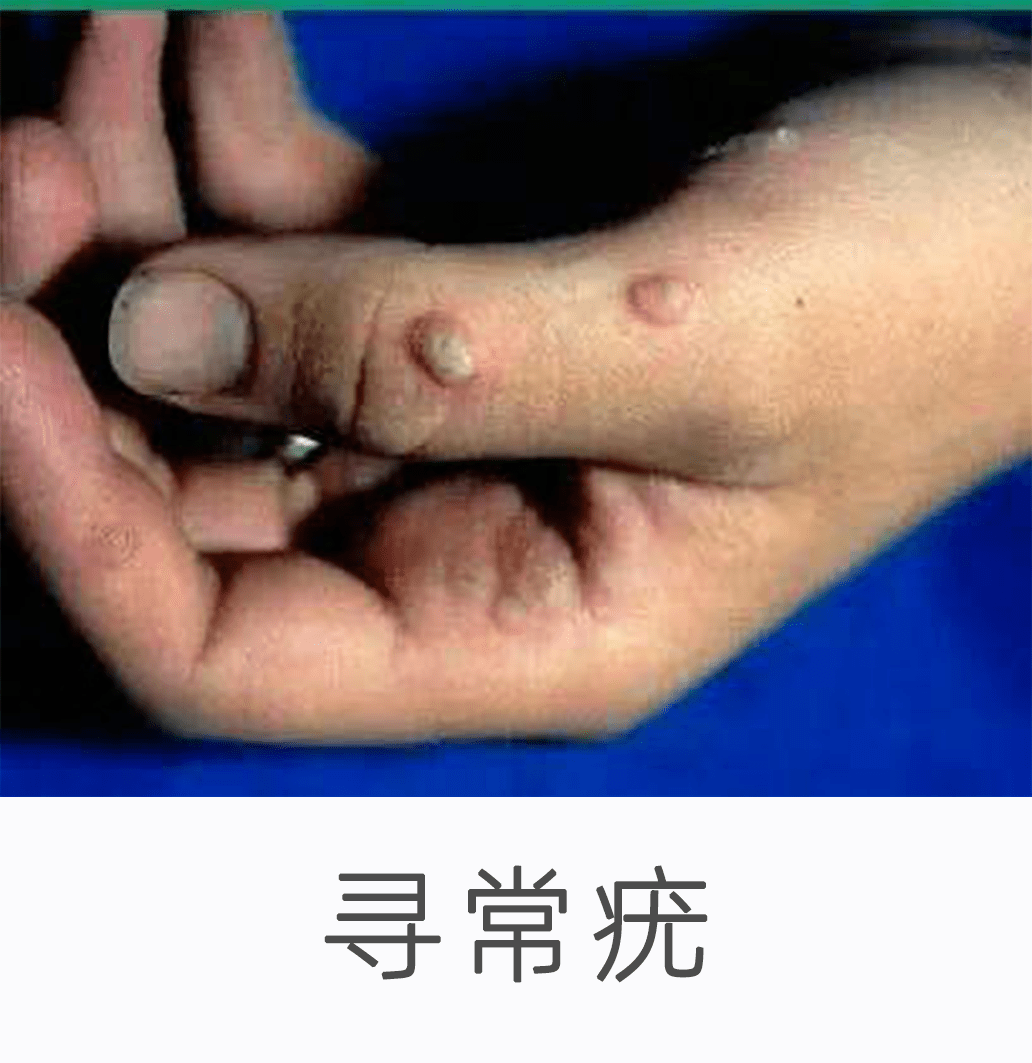女人感染hpv会自愈吗（hpv女生感染症状）