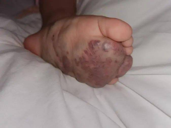 毛细血管畸形▲ 卡波西样血管内皮瘤▲ 婴幼儿血管瘤血管瘤门诊