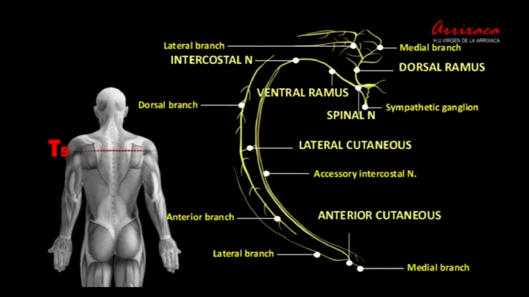 徐医附院麻醉科超声引导下竖脊肌平面阻滞