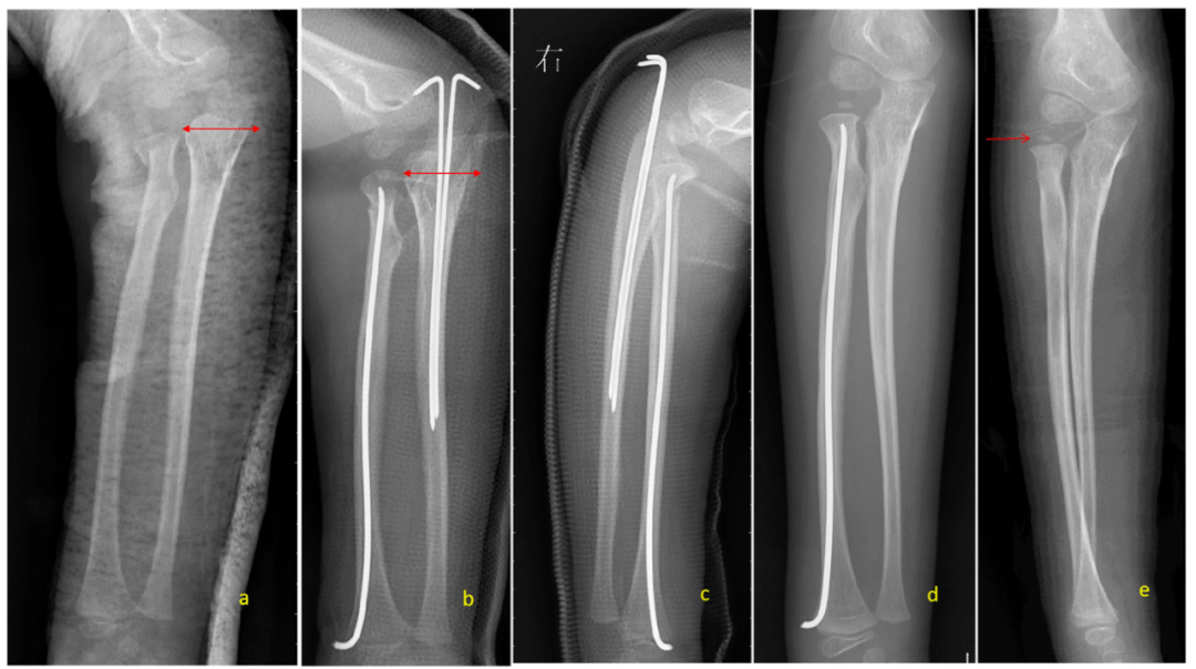 中国儿童骨科医生在国际骨科期刊发表儿童肘关节骨折新分型转载自唯医