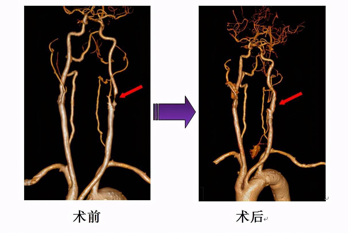 颈动脉狭窄中风随后就到医生提示这些症状别再视而不见