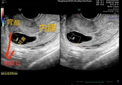 剖宫产瘢痕的超声图片图片