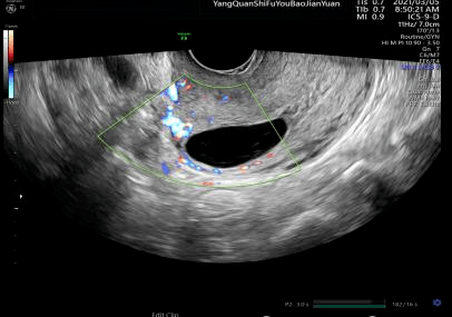 瘢痕子宫超声图片
