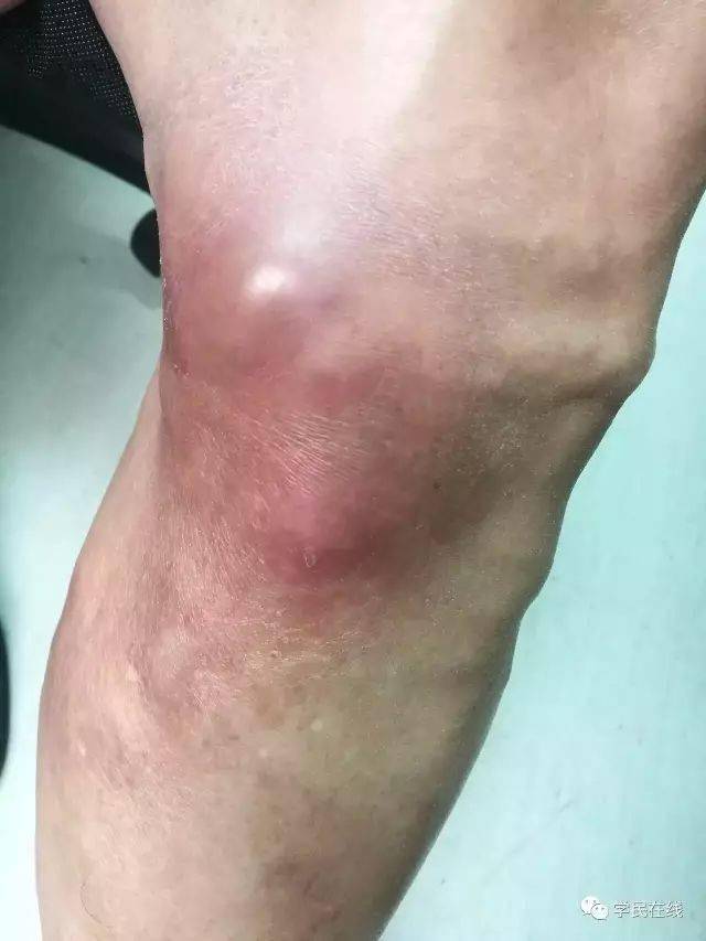 引发大猝死久坐族静脉曲张没你想那样简单