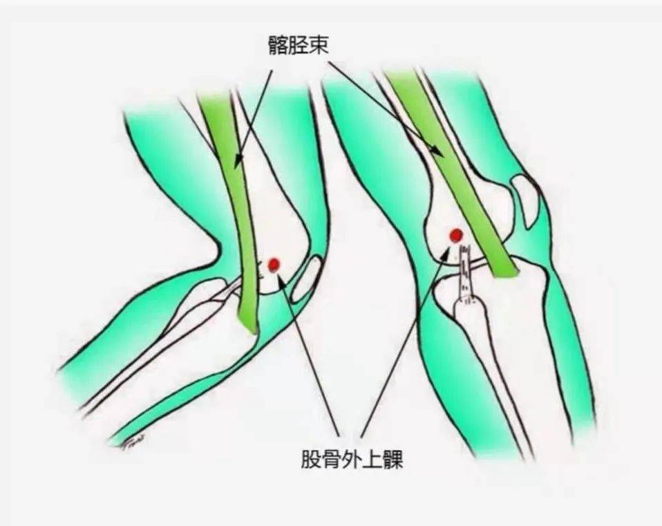 跑步膝又称"髂胫束摩擦综合征"和"股骨外上髁炎,是膝关节外侧疼痛的