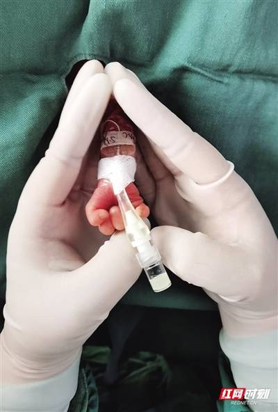 南华附一医院新生儿科:成功为800克 "巴掌宝宝" 筑起"生命线"