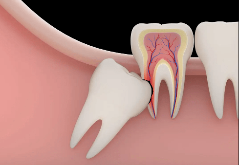 ③智齿与相邻牙的接触关系不好,易导致食物嵌塞,形成龋齿.