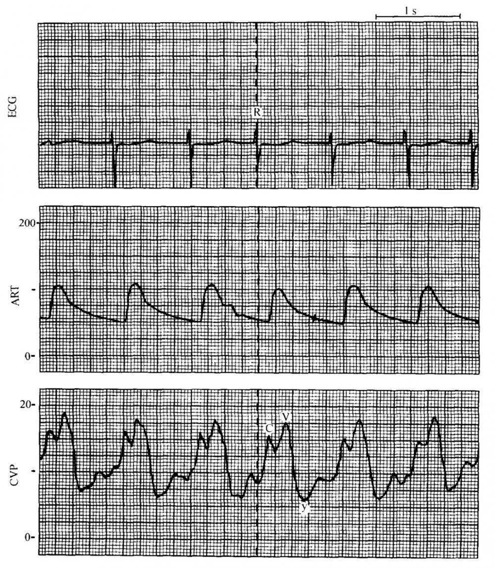 (注:大a波[*],心房收缩时三尖瓣处于关闭状态)图5房室分离图4心房颤动