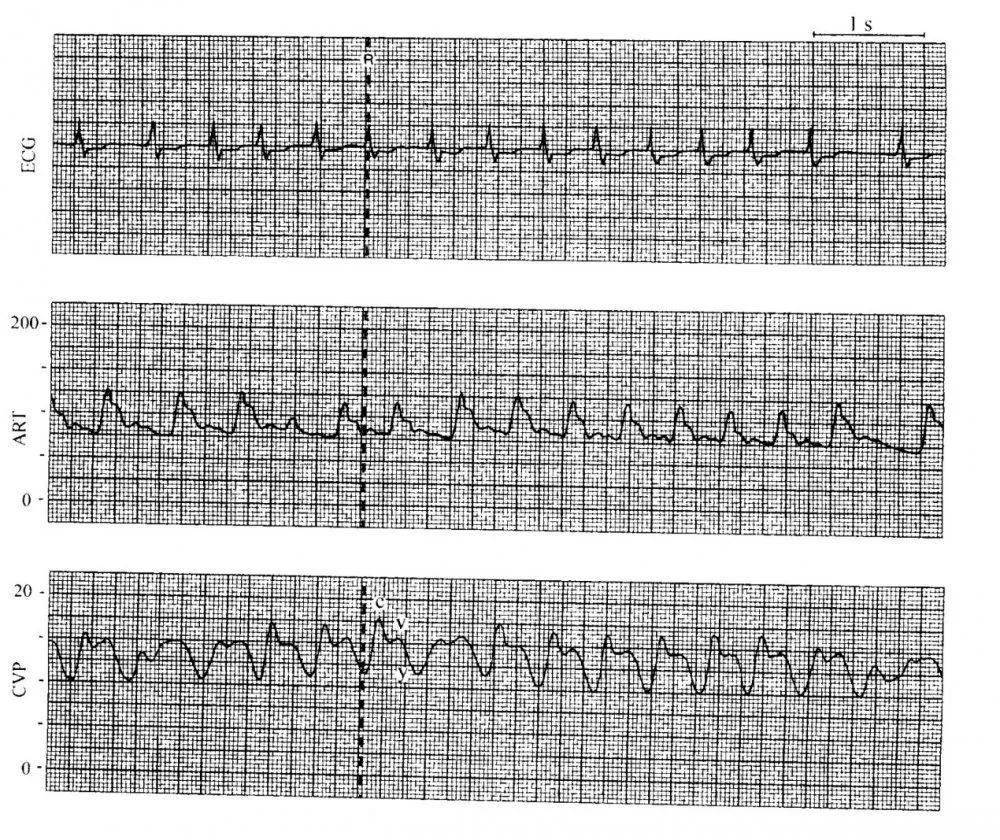 瑞金麻醉与围术期医学中心静脉压解读