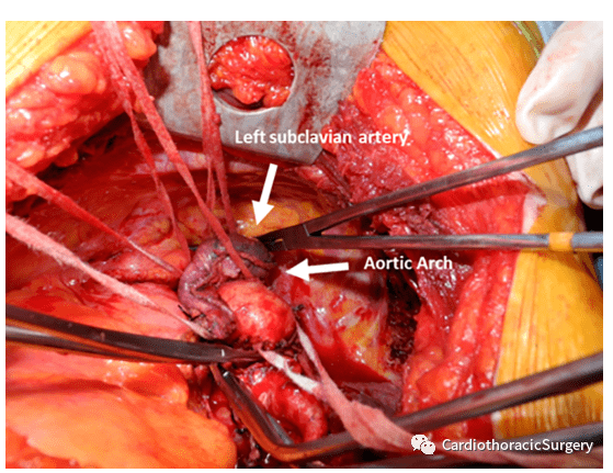 直接交叉钳夹术切除侵犯主动脉弓或锁骨下动脉的肺癌
