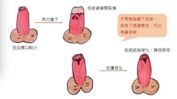 如何正确帮小孩翻包茎图片