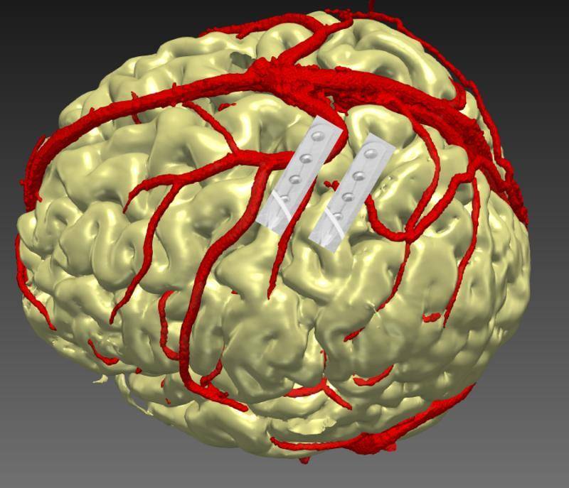 浙大|脑机接口应用新突破，浙大团队研发脑“反导系统”抑制癫痫