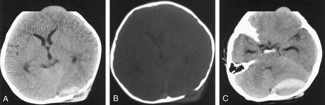 頭顱 ct 平掃結果如下:實驗室檢查:血尿常規,凝血功能,生化結果正常.