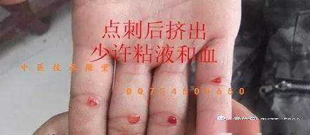 神奇的四缝穴挑治_手指