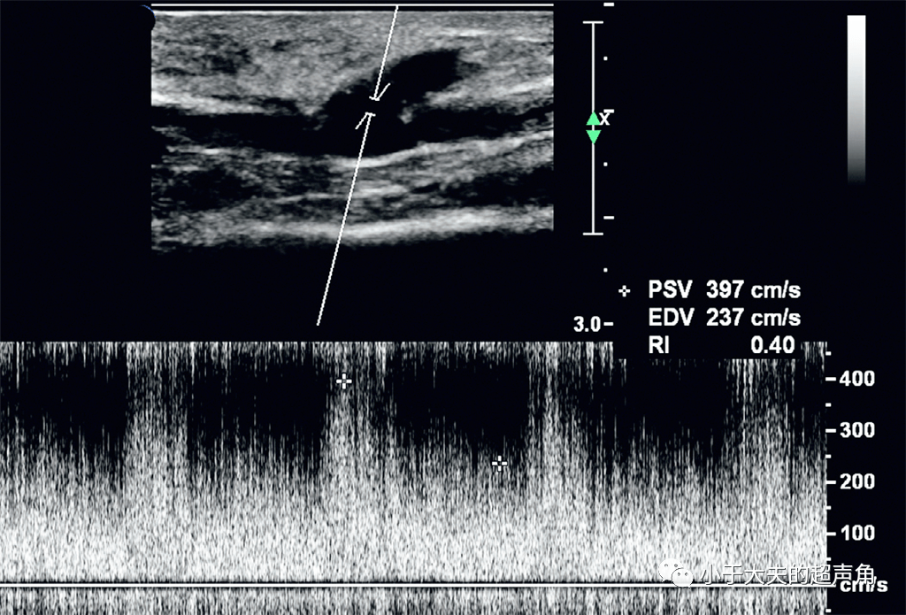 子宫动静脉瘘超声图片