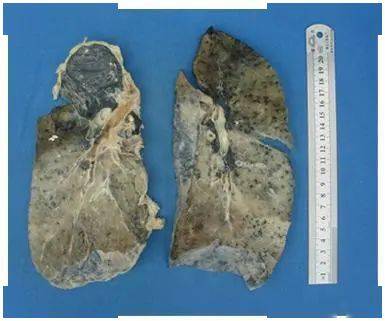 尘肺照片图片