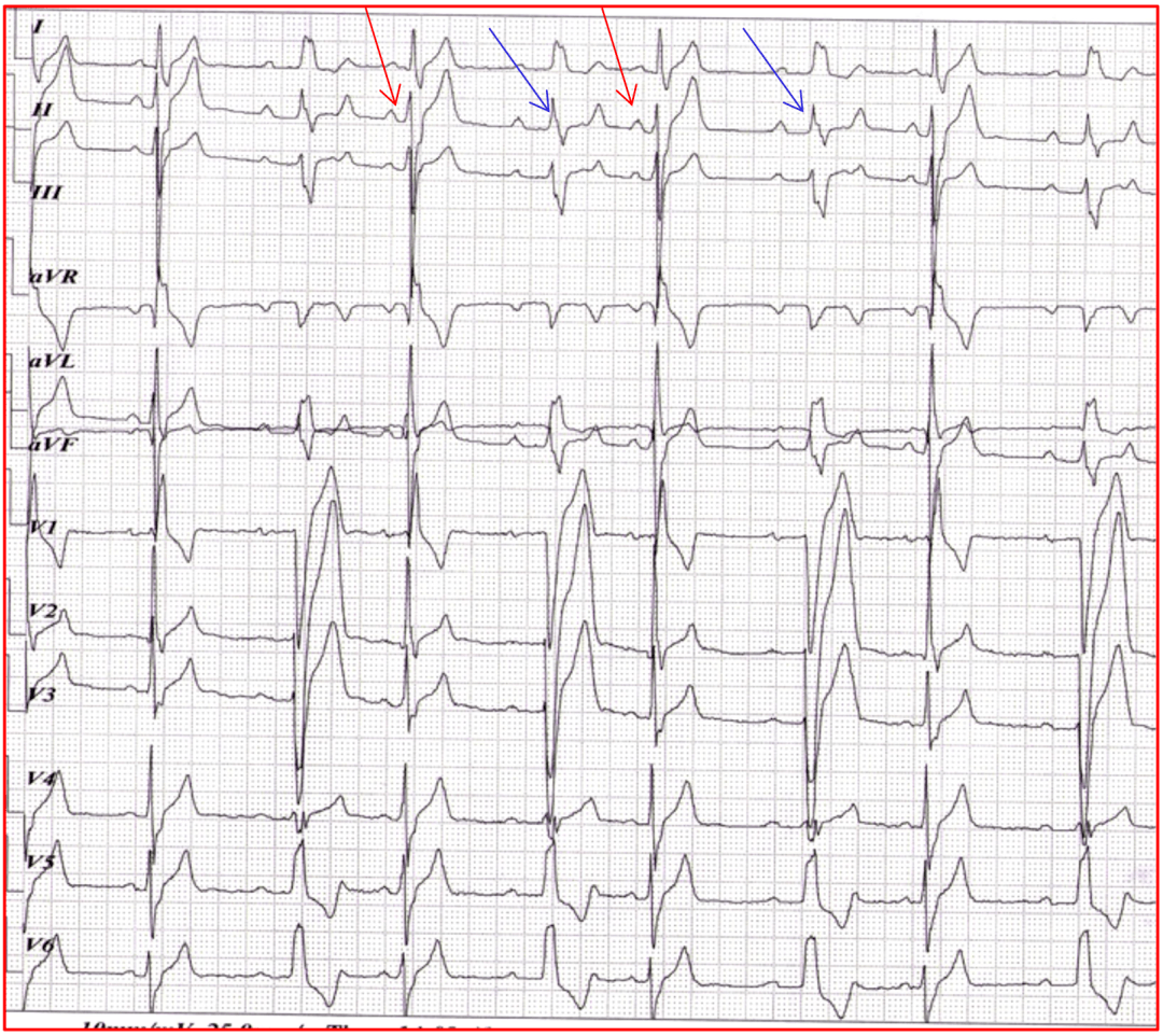 右束支阻滞合并其他心电异常如何识别进阶篇