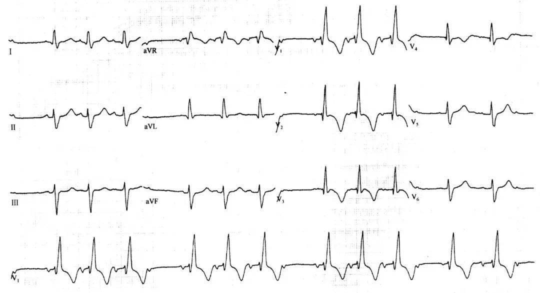 右束支阻滞合并其他心电异常如何识别进阶篇