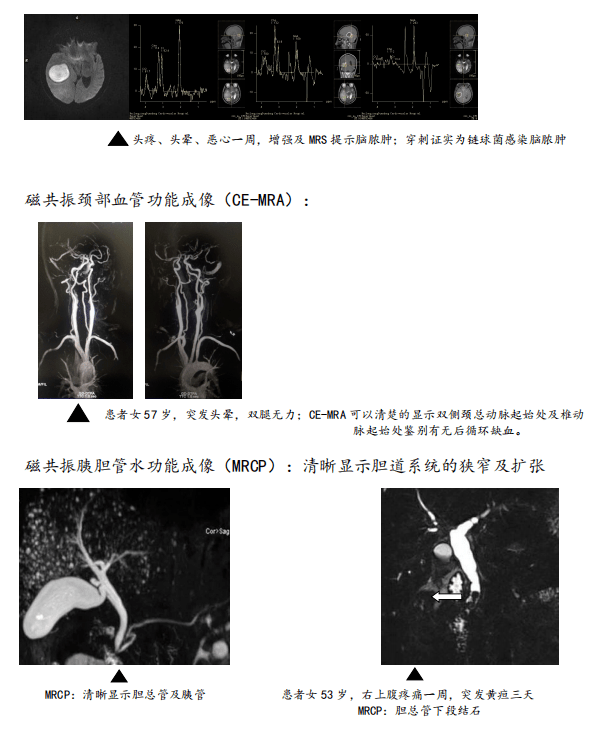 检查中：磁共振头部弥散加权功能成像（dwi）：能够发现早期（4-6h）脑梗死此外还可以进行dti，以