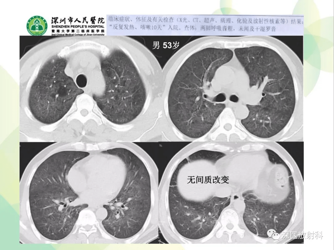 肺瀰漫性磨玻璃密度病變的ct診斷