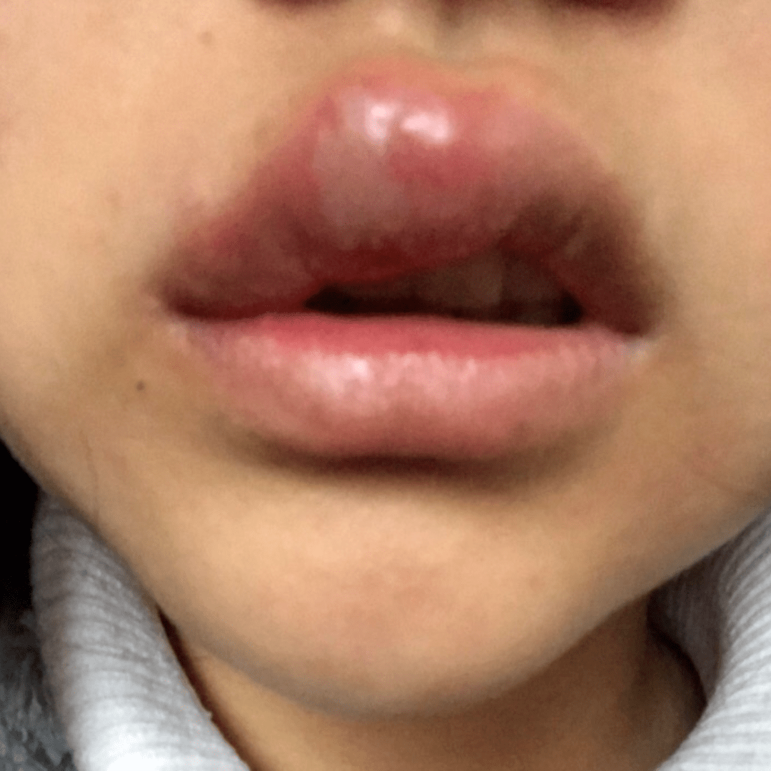 嘴角长疱疹是什么原因(脓痂疹)_金纳莱网