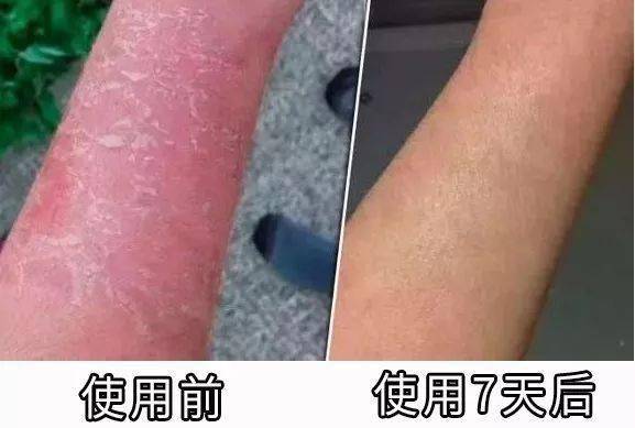 溼疹皮炎有救了抹它1秒止癢3天去疹10年不復發