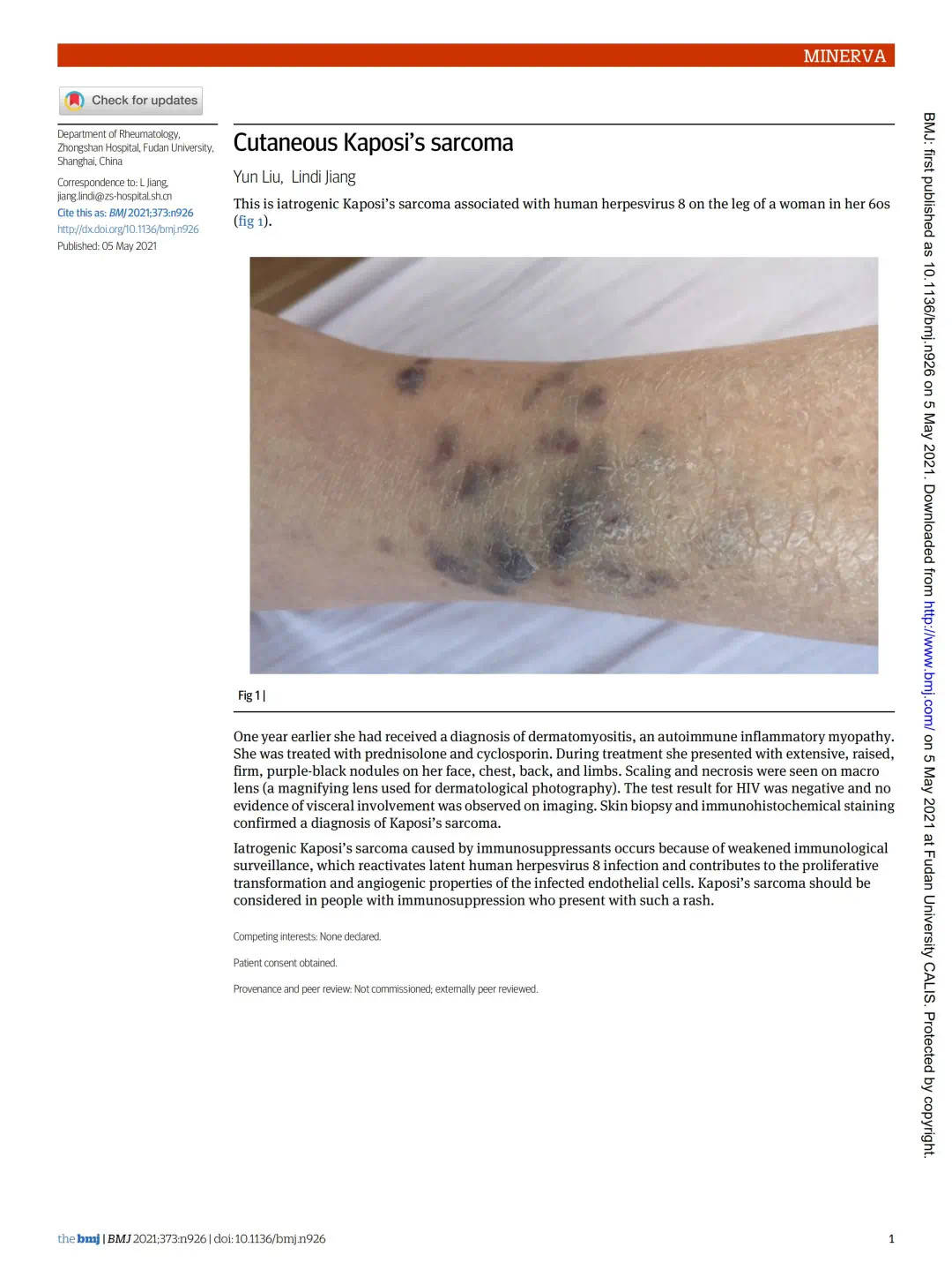 发表题为"cutaneous kaposis sarcoma"-皮肤卡波西肉瘤的病例报告