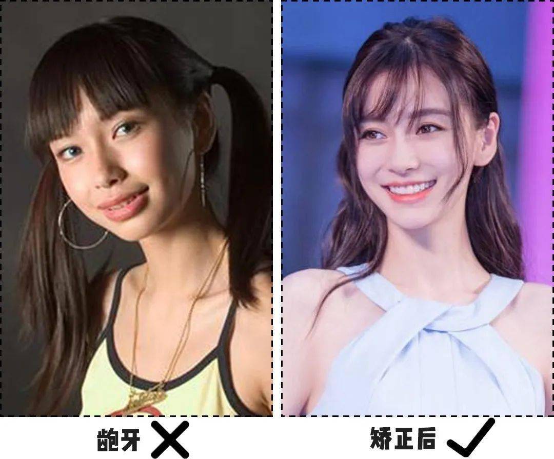 戴牙套换张脸尤其是有这3个特点的女生