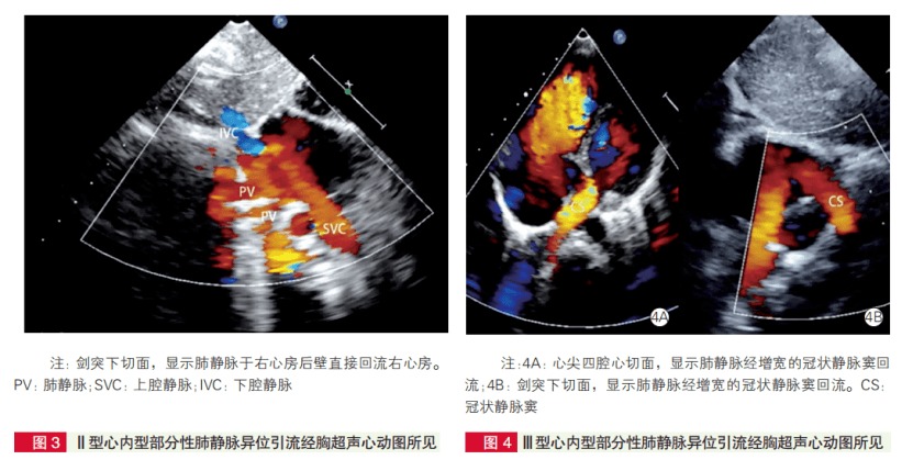 作者指出,结合本组病例的经胸超声心动图诊断经验,心内型papvc各细化