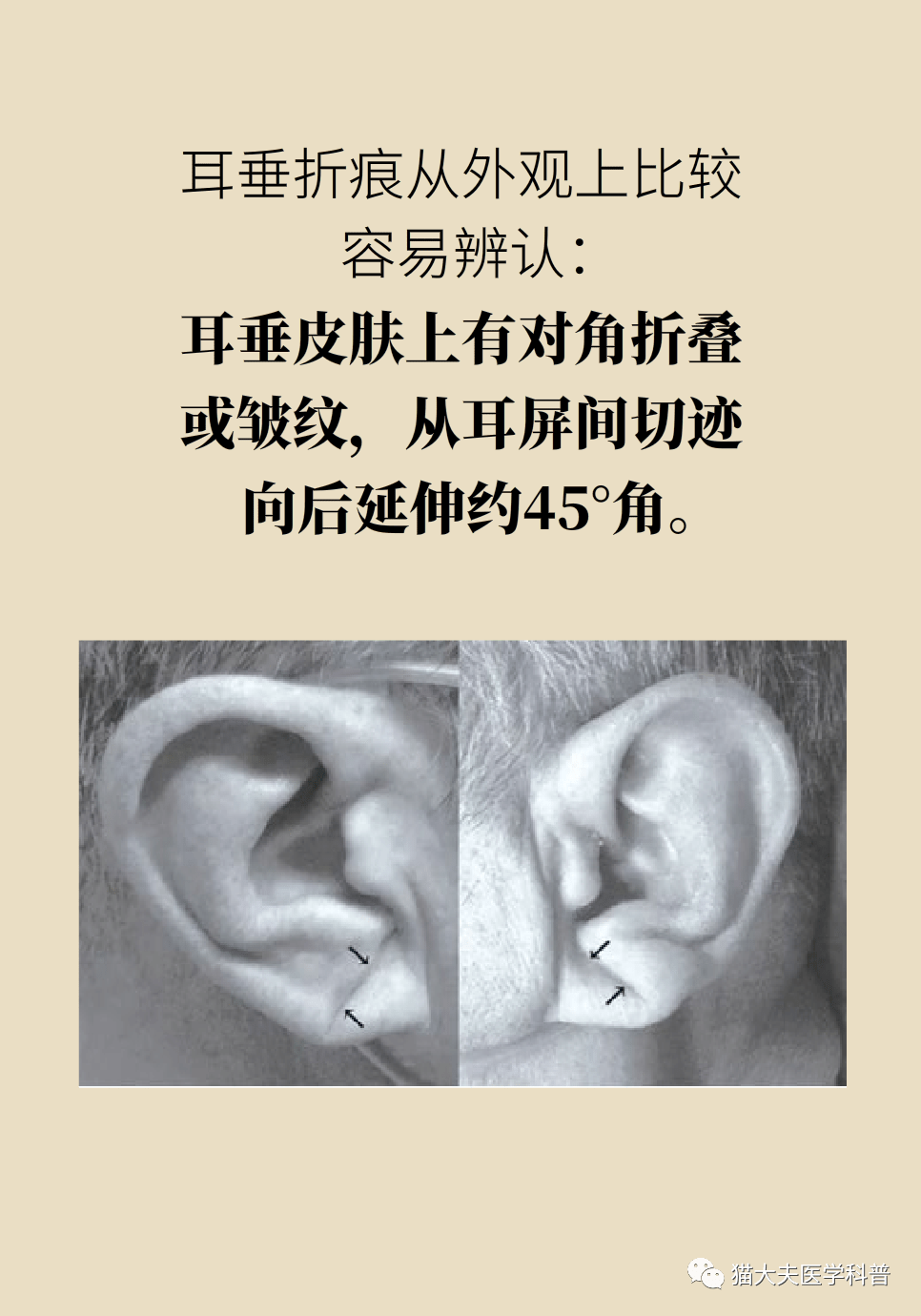 老人耳垂收缩 临终图片