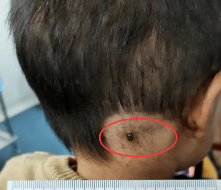 惊2岁小孩被虫子吸血多天它涨大几十倍取下来还活着