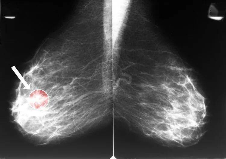 湿疹样乳腺癌初期图片图片