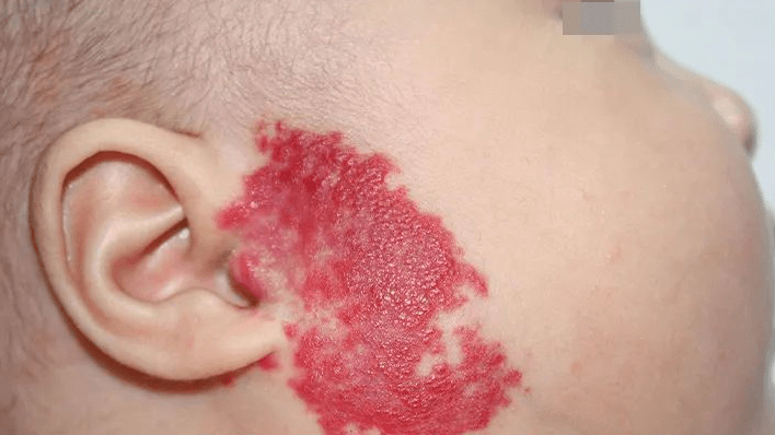 治血管瘤多少钱血管瘤治疗收费标准是什么