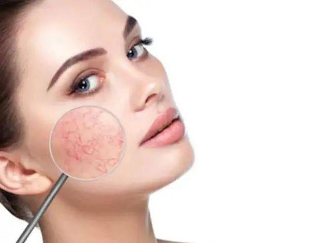 脸部出现这些变化,有可能是"敏感肌",方法有这3个!_皮肤