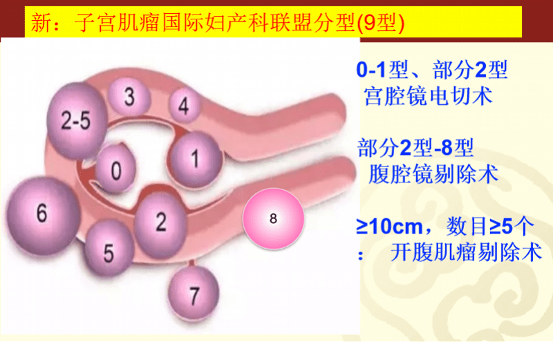 子宫肌瘤是由子宫平滑肌细胞增生而成的一类肿瘤,又称子宫平滑肌瘤,是