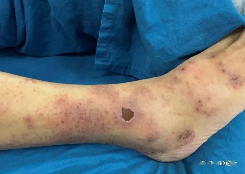 患者李某某,男,63岁,以"多饮,多食 20年,血液透析 6年,足部皮肤溃烂2